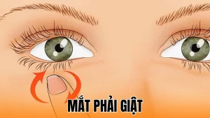 Mắt phải giật